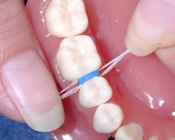 Flossing spacer between teeth