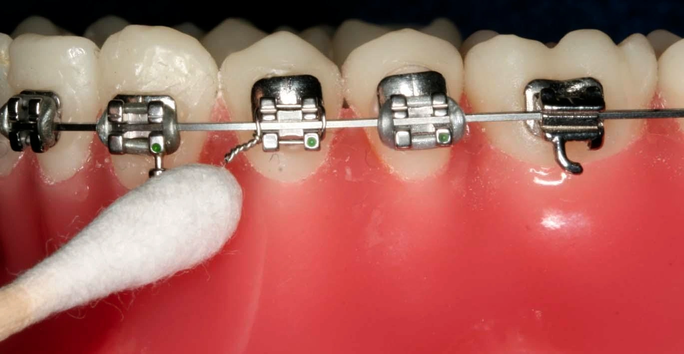 Pushing steel tie with Q-tip