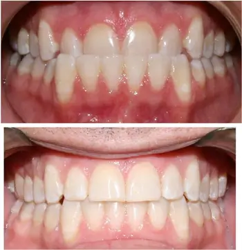 Underbite Correction